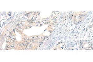 Immunohistochemistry of paraffin-embedded Human gastric cancer tissue using NOG Polyclonal Antibody at dilution of 1:50(x200) (NOG anticorps)