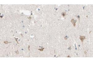 ABIN6274420 at 1/100 staining Human brain cancer tissue by IHC-P.