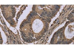 Immunohistochemistry of paraffin-embedded Human colon cancer tissue using MYO18B Polyclonal Antibody at dilution 1:50