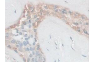 Detection of FSTL1 in Human Breast cancer Tissue using Polyclonal Antibody to Follistatin Like Protein 1 (FSTL1) (FSTL1 anticorps  (AA 21-308))