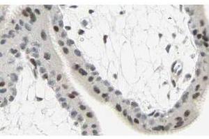 Affinity Purified anti-Smad3 antibody shows strong cytoplasmic and membranous staining of tumor cells in cancerous human liver tissue.