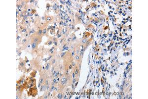 Immunohistochemistry of Human cervical cancer using IL18 Polyclonal Antibody at dilution of 1:100 (IL-18 anticorps)
