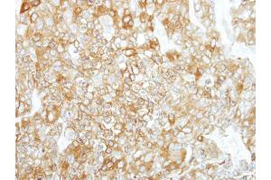 IHC-P Image Immunohistochemical analysis of paraffin-embedded BT474 xenograft, using Calpain 1, antibody at 1:500 dilution.