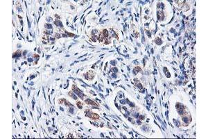Immunohistochemical staining of paraffin-embedded Carcinoma of Human lung tissue using anti-HARS2 mouse monoclonal antibody. (HARS2 anticorps)