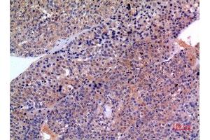 Immunohistochemistry (IHC) analysis of paraffin-embedded Human Liver Cancer, antibody was diluted at 1:100. (SCCA1/2 (Internal Region) anticorps)