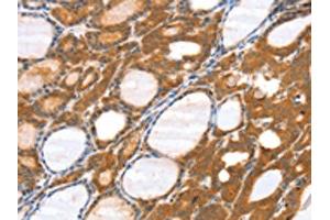 The image on the left is immunohistochemistry of paraffin-embedded Human thyroid cancer tissue using ABIN7131182(SRGAP3 Antibody) at dilution 1/40, on the right is treated with fusion protein. (SRGAP3 anticorps)