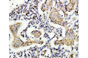 IHC-P: Caspase-8 antibody testing of human breast cancer tissue (Caspase 8 anticorps  (AA 458-473))