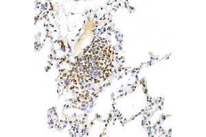 Immunohistochemistry of paraffin-embedded human colon carcinoma using MUC2 Rabbit pAb (ABIN7268690) at dilution of 1:300 (40x lens).