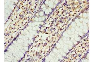 Immunohistochemistry of paraffin-embedded human colon cancer using ABIN7168957 at dilution of 1:100 (STRAP anticorps  (AA 1-350))