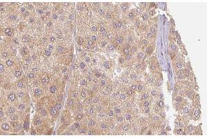 ABIN6277408 at 1/100 staining Human Melanoma tissue by IHC-P. (MMP11 anticorps  (N-Term))