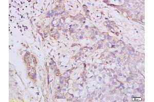 Formalin-fixed and paraffin embedded human esophageal carcinoma labeled with Anti phospho-PKA R2 (Ser96) Polyclonal Antibody, Unconjugated (ABIN752668) at 1:200 followed by conjugation to the secondary antibody and DAB staining (PRKAR2A anticorps  (pSer96))