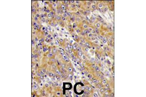 Formalin-fixed and paraffin-embedded human prostate carcinoma tissue reacted with MYO1C polyclonal antibody  , which was peroxidase-conjugated to the secondary antibody, followed by DAB staining . (Myosin IC anticorps  (C-Term))