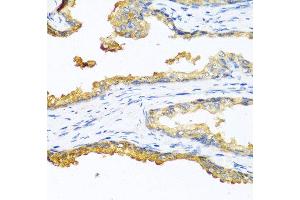 Immunohistochemistry of paraffin-embedded human prostate cancer using CPB2 antibody at dilution of 1:100 (40x lens). (CPB2 anticorps)