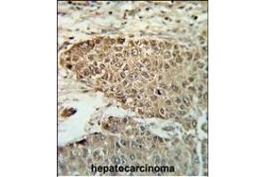 Formalin-fixed and paraffin-embedded human hepatocarcinoma reacted with BIN3 Antibody (N-term), which was peroxidase-conjugated to the secondary antibody, followed by DAB staining.
