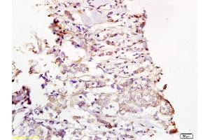 Formalin-fixed and paraffin embedded human breast carcinoma labeled with Rabbit Anti Phospho-MEK1/2(Ser218/222) Polyclonal Antibody, Unconjugated (ABIN743813) at 1:200 followed by conjugation to the secondary antibody and DAB staining (MEK1/2 anticorps  (pSer218, pSer222))