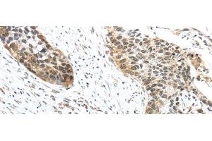 Immunohistochemistry of paraffin-embedded Human esophagus cancer tissue using TRIP6 Polyclonal Antibody at dilution 1:50 (TRIP6 anticorps)