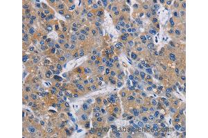 Immunohistochemistry of Human liver cancer using GPM6A Polyclonal Antibody at dilution of 1:40 (GPM6A anticorps)
