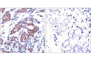 Immunohistochemistry analysis of paraffin-embedded human breast carcinoma, using Elk1 (Phospho-Ser383) Antibody. (ELK1 anticorps  (AA 351-400))