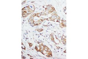 Anti-IGF1 antibody, IHC(P) IHC(P): Human Mammary Cancer Tissue (IGF1 anticorps  (Middle Region))