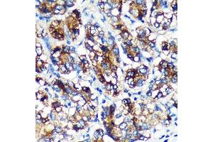 Immunohistochemistry of paraffin-embedded Human liver cancer using EML4 Rabbit pAb (ABIN7266891) at dilution of 1:100 (40x lens).