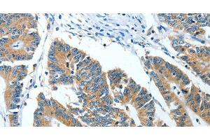 Immunohistochemistry of paraffin-embedded Human colon cancer tissue using ANGPT1 Polyclonal Antibody at dilution 1:50