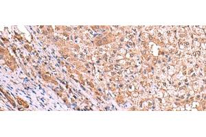 Immunohistochemistry of paraffin-embedded Human liver cancer tissue using TTC38 Polyclonal Antibody at dilution of 1:85(x200) (TTC38 anticorps)