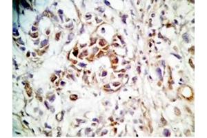 Human stomach cancer tissue was stained by rabbit anti-Spexin(H) Antiserum (Spexin anticorps)