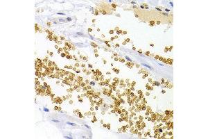 Immunohistochemistry of paraffin-embedded human stomach cancer using OPRL1 antibody at dilution of 1:200 (400x lens). (OPRL1 anticorps)