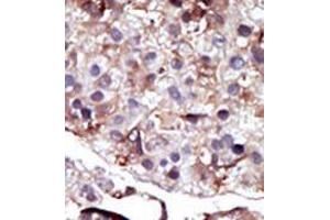 Formalin-fixed and paraffin-embedded human cancer tissue (hepatocarcinoma) reacted with the primary antibody, which was peroxidase-conjugated to the secondary antibody, followed by AEC staining.
