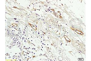 Formalin-fixed and paraffin embedded human colon tissue labeled with Anti Prominin2 Polyclonal Antibody, Unconjugated (ABIN715151) at 1:200 followed by conjugation to the secondary antibody and DAB staining (Prominin 2 anticorps  (AA 301-400))