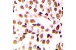 Immunohistochemical analysis of NFYB staining in human breast cancer formalin fixed paraffin embedded tissue section.