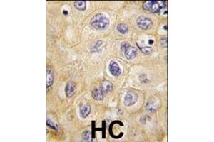 Formalin-fixed and paraffin-embedded human hepatocarcinoma tissue reacted with hCLDN1-Loop1 (ABIN390289 and ABIN2840728) , which was peroxidase-conjugated to the secondary antibody, followed by DAB staining.