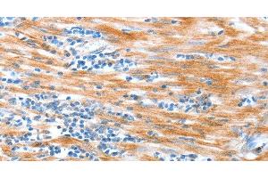 Immunohistochemistry of paraffin-embedded Human esophagus cancer using ALDOB Polyclonal Antibody at dilution of 1:40 (ALDOB anticorps)