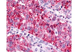 Anti-GPR88 antibody IHC of human Ovary, Carcinoma. (GPR88 anticorps  (Cytoplasmic Domain))