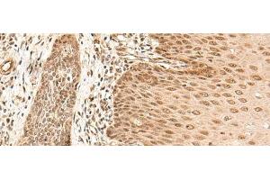 Immunohistochemistry of paraffin-embedded Human esophagus cancer tissue using ARMC8 Polyclonal Antibody at dilution of 1:40(x200) (ARMC8 anticorps)