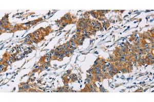 Immunohistochemistry of paraffin-embedded Human gastic cancer using PIP4K2A Polyclonal Antibody at dilution of 1:40 (PIP4K2A anticorps)