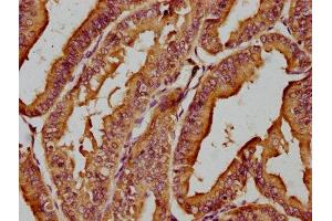 IHC image of ABIN7141990 diluted at 1:200 and staining in paraffin-embedded human endometrial cancer performed on a Leica BondTM system.