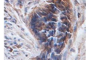 Immunohistochemical staining of formalin-fixed paraffin-embedded human colon carcinoma tissue showing cytoplasmic staining with PTPN12 polyclonal antibody  at 1 : 100 dilution. (PTPN12 anticorps  (AA 544-771))