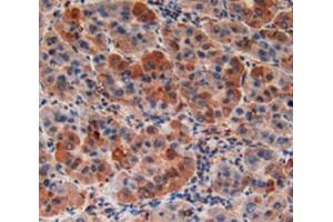 Detection of RXFP1 in Human Liver Cancer Tissue using Polyclonal Antibody to Relaxin/Insulin Like Family Peptide Receptor 1 (RXFP1)