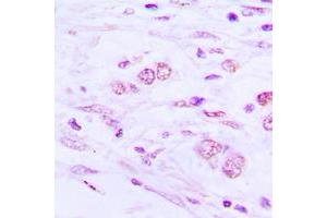 Immunohistochemical analysis of BAIAP2L1 staining in human lung cancer formalin fixed paraffin embedded tissue section. (BAIAP2L1 anticorps  (Center))