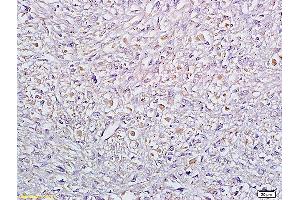 Formalin-fixed and paraffin embedded human cervical carcinoma labeled with Anti Sertad1 Polyclonal Antibody, Unconjugated (ABIN720011) at 1:200 followed by conjugation to the secondary antibody and DAB staining (SERTAD1 anticorps  (AA 1-42))