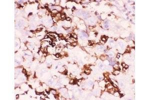 IHC-P: LFA-1 antibody testing of human lung cancer tissue (ITGAL anticorps  (AA 404-769))