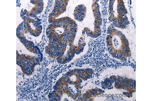 Immunohistochemistry of Human colon cancer using DUSP6 Polyclonal Antibody at dilution of 1:50 (DUSP6 anticorps)