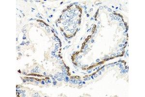 Immunohistochemistry of paraffin-embedded Human prostate using BMP5 Polyclonal Antibody at dilution of 1:100 (40x lens).