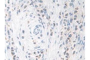 Detection of KLK11 in Human Stomach cancer Tissue using Polyclonal Antibody to Kallikrein 11 (KLK11)