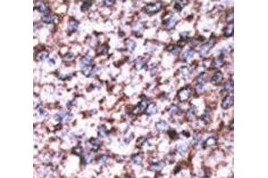 IHC analysis of FFPE human hepatocarcinoma stained with the BACE2C antibody (BACE2C anticorps  (AA 310-339))