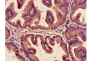 Immunohistochemistry of paraffin-embedded human prostate cancer using ABIN7149190 at dilution of 1:100 (Cytochrome C1 anticorps  (AA 85-325))