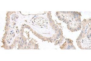 Immunohistochemistry of paraffin-embedded Human thyroid cancer tissue using STAU2 Polyclonal Antibody at dilution of 1:45(x200) (Double-stranded RNA-binding protein Staufen homolog 2 (STAU2) anticorps)