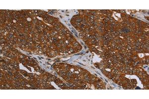 Immunohistochemistry of paraffin-embedded Human ovarian cancer using MCHR1 Polyclonal Antibody at dilution of 1:30