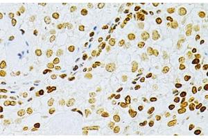 Immunohistochemistry of paraffin-embedded Human cancer using DKC1 Polyclonal Antibody at dilution of 1:200 (40x lens). (DKC1 anticorps)